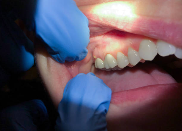 Best Emergency Broken Tooth Repair in Briarcliff, TX