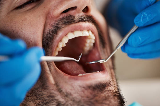 Best Emergency Tooth Extraction in Briarcliff, TX